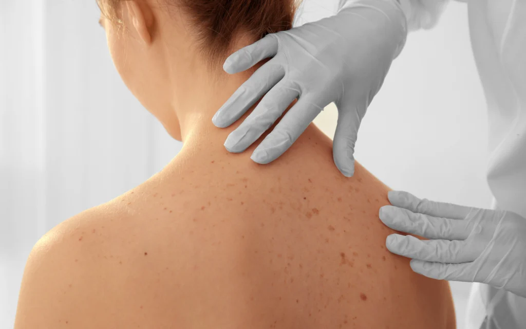 Skin Tags Contagious