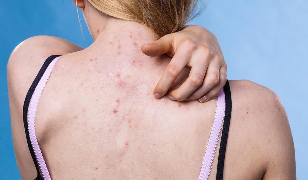 Back Cheeks Understanding Back Acne Causes and Chest Breakouts